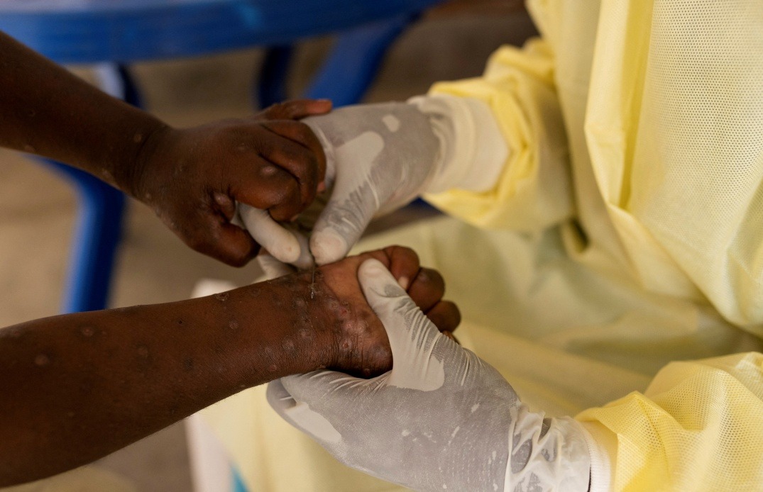 Africa launches $600 million plan to combat spreading Mpox outbreak