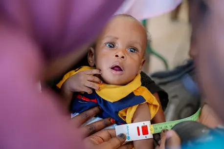 Sudan: Child malnutrition surges in Darfur amid deepening crisis, warns UNICEF