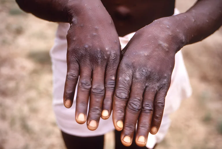 West Africa: mpox situation more complex despite lifting of global alert